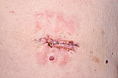 Infection and allergic rash following surgery