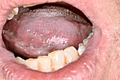 Leukoplakia under the tongue