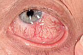 Episcleritis