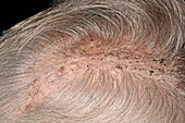 Post-operative craniotomy scar