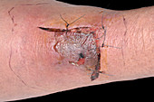 Stitched leg wound
