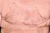 Bilateral breast cancer removal scars