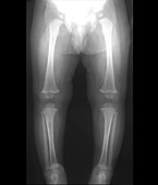 Leg bones of 18-month-old infant, X-ray