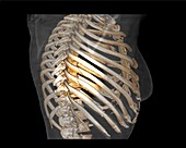Rib fractures, 3D CT scan