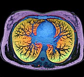 Heart and lungs, CT scan