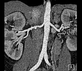 Fibromuscular dysplasia of renal artery, CT scan