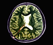 Hydrocephalus treatment, MRI scan