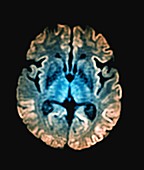 Creutzfeldt-Jakob disease, MRI scan