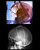 Parkinson's disease brain stimulation operation, X-rays
