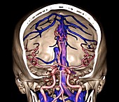Brain arteries and venous sinuses, 3D CT angiogram