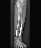 Pinned fractured lower arm bones, X-ray