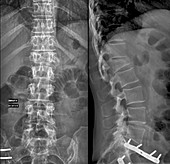 Compression fracture of a lumbar vertebra, X-ray