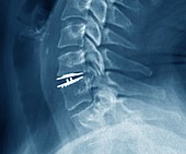 Cervical intervertebral disc implant, X-ray