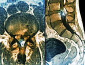 Slipped disc in the lumbar spine, MRI scans