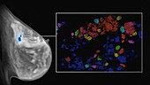 Breast MRI, Cancer Cells