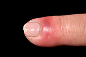 Finger infection