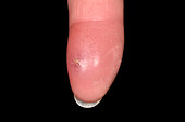 Finger infection