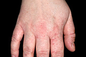 Eczema on the hand