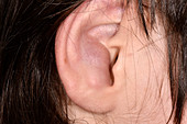 Ear seroma in cerebral palsy