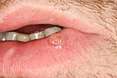 Pyogenic granuloma