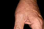 Gout of the thumb