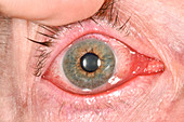 Viral conjunctivitis