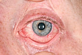 Allergic conjunctivitis