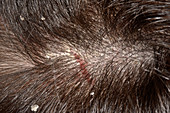 Psoriasis of the scalp