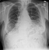 Pulmonary fibrosis, X-ray