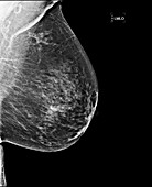 Breast cancer, X-ray