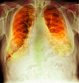 Pulmonary fibrosis, X-ray