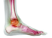 Osteoarthritis of the ankle, X-ray