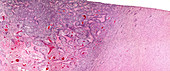 Glioblastoma multiforme, light micrograph