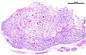 Breast fibroadenoma, light micrograph