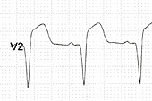 ECG trace for a heart attack, electrode V2