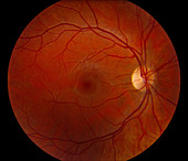 Fundus image of normal retina