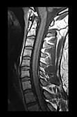 Normal MRI Cervical Spine