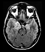 DNET Brain Tumour