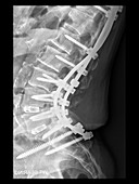 Spinal Instrumentation Lumbar Region