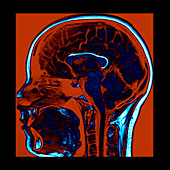 Enhanced Lipoma of Corpus Callosum