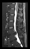 Lumbar Disc Herniations on MRI