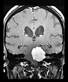 MRI Large Acoustic Schwannoma (Vestibular Schwannoma)