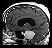 MRI Large Acoustic Schwannoma (Vestibular Schwannoma)