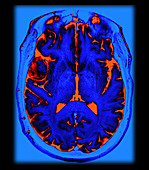 Enhanced Pterional Meningioma on MRI