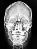 Frontal X-ray of Skull