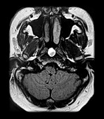 MRI Tornwaldt Cyst Nasopharynx