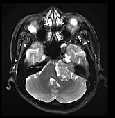 MRI Vestibular Schwannoma and Cavernous Sinus Lesion