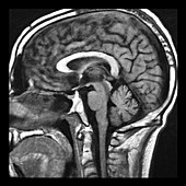 Wernicke's Encephalopathy on MRI