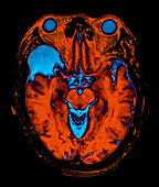 Enhanced MRI of Arachnoid Cyst