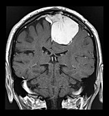 Parafalcine Meningioma MRI